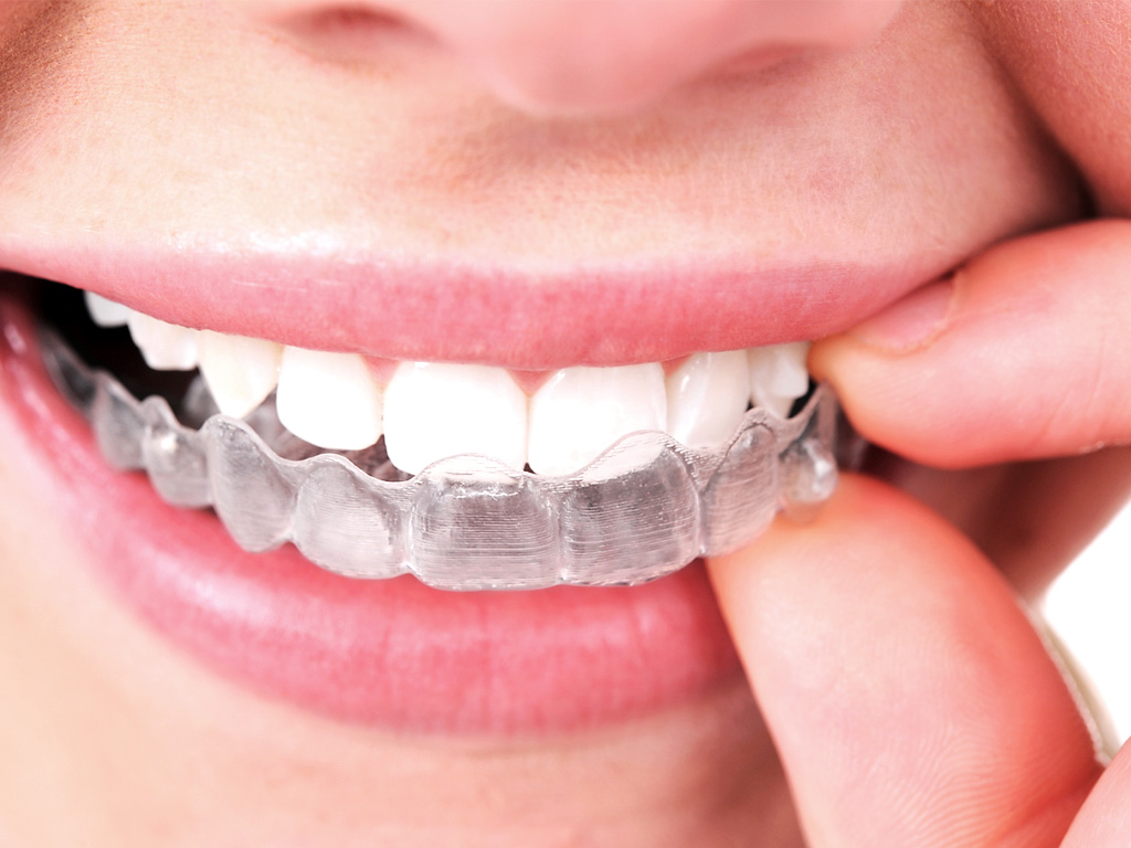 Arquivos Invisalign - Levy Odontologia